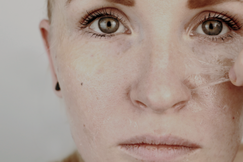 Chemical peeling on woman's face