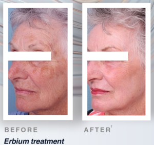 Before and after Spectrum’s Erbium laser treatments