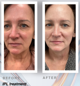 Before and after Spectrum’s IPL laser treatments